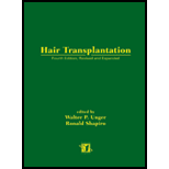 Hair Transplantation