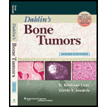 Dahlins Bone Tumors General Aspects and Data on 10,165 Cases